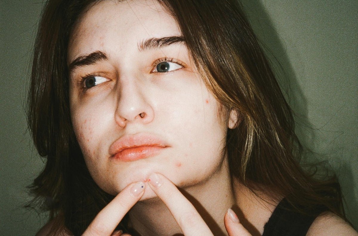Acne Ormonale: cause e soluzioni